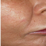 blizny po użyciu lasera