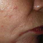 blizny przed użyciem lasera