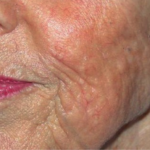 widok naczynek po użyciu lasera