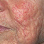 widok naczynek przed użyciem lasera