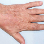 widok przebarwień po użyciu lasera