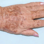 widok przebarwień przed użyciem lasera