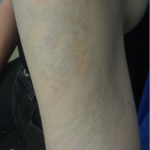 tatuaż po użyciu lasera