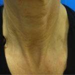 widok zmarszczek po użyciu lasera