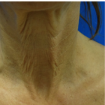 widok zmarszczek przed użyciem lasera