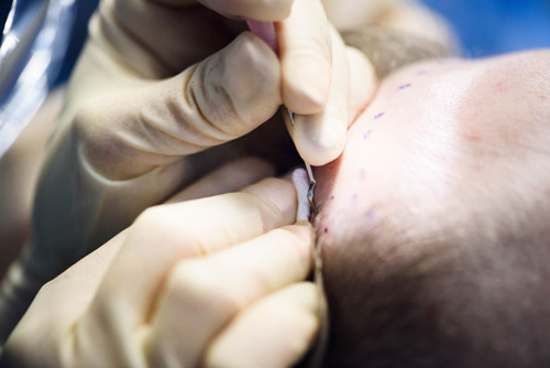 przeszczep-2749 przeszczep-2749