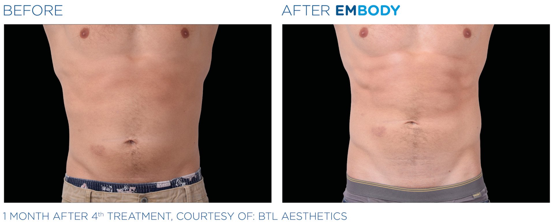 Zdjęcie przed i po zabiegu