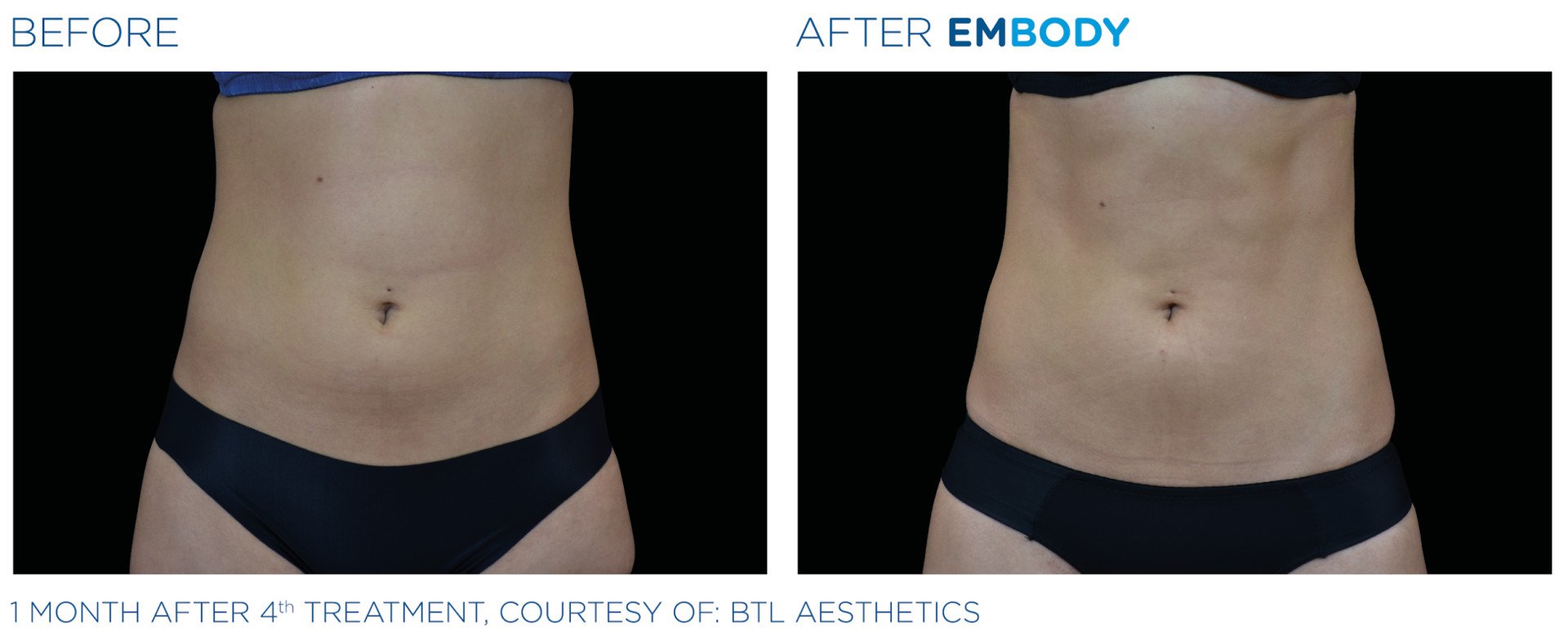 Zdjęcie przed i po zabiegu