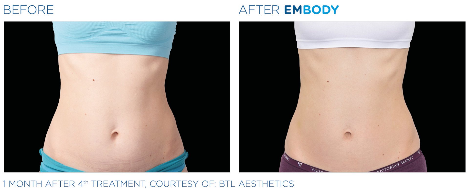 Zdjęcie przed i po zabiegu