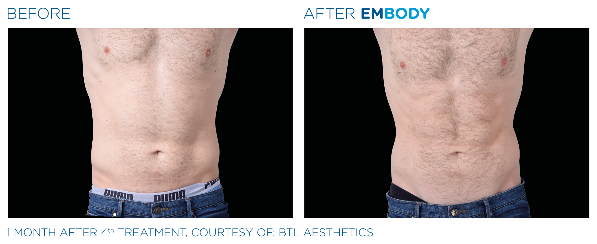 Zdjęcie przed i po zabiegu