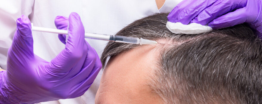 ile kosztuje przeszczep włosów