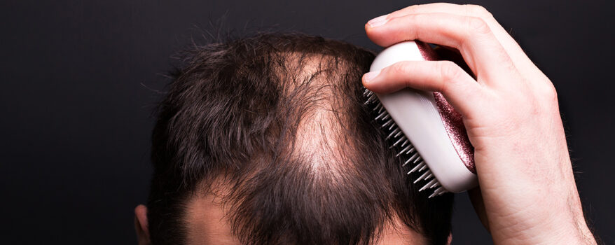 łysienie telogenowe